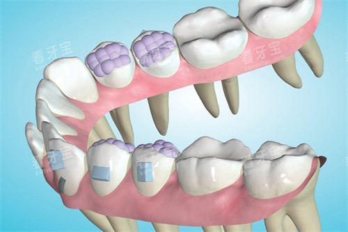 Spark精靓隐形矫正器方案设计时可以看到牙根 Spark精靓隐形矫正器方案设计时可以看到牙根