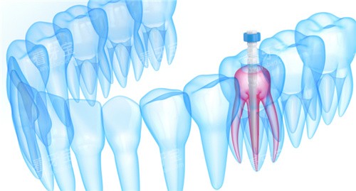 牙齿内部根管透视图 牙齿内部根管透视图