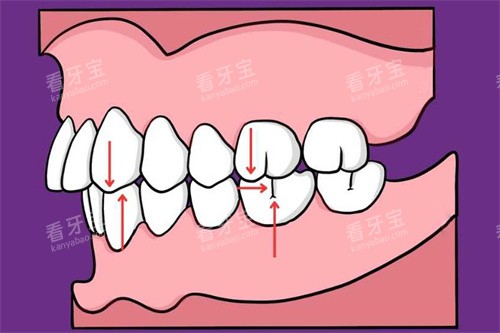 安氏二类图 安氏二类图