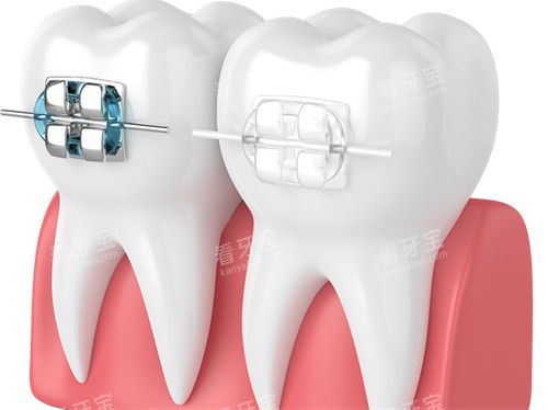 牙齿矫正金属托槽及陶瓷托槽漫画图 牙齿矫正金属托槽及陶瓷托槽漫画图