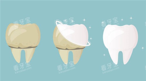 牙齿清洗前后对比 牙齿清洗前后对比