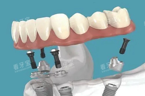 all-on-4��ֲ��ͨͼ