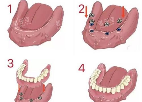吸附式假牙的原理 吸附式假牙的原理