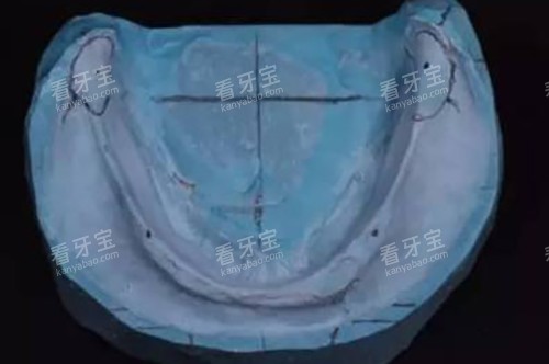 义齿牙模制作 义齿牙模制作