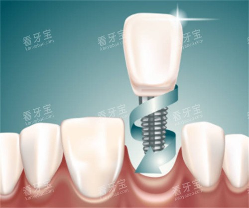 种植牙在口腔图 种植牙在口腔图