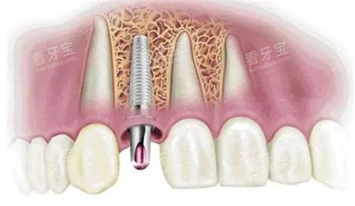 ��ֲ������ģ��ͼ