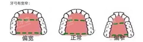 牙齿矫正牙弓形状 牙齿矫正牙弓形状