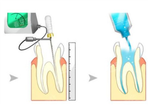 根管治疗操作步骤 根管治疗操作步骤