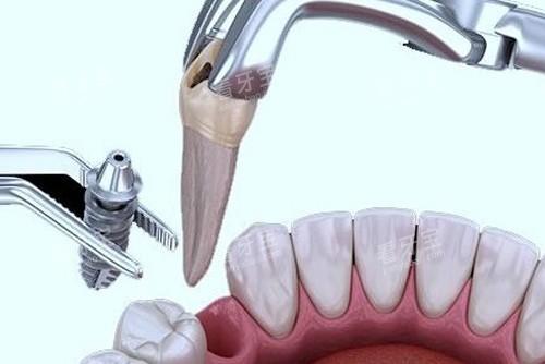 ������װ��ֲ��ʾ��ͼ