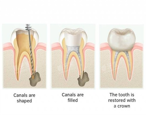 根管治疗手术步骤 根管治疗手术步骤