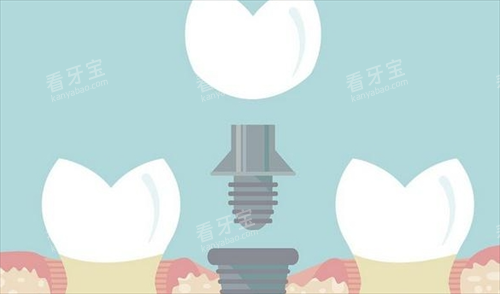 组成种植牙的三部分动画展示 组成种植牙的三部分动画展示