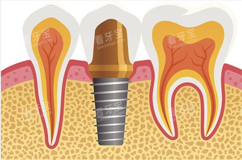 种植牙和临牙图片 种植牙和临牙图片