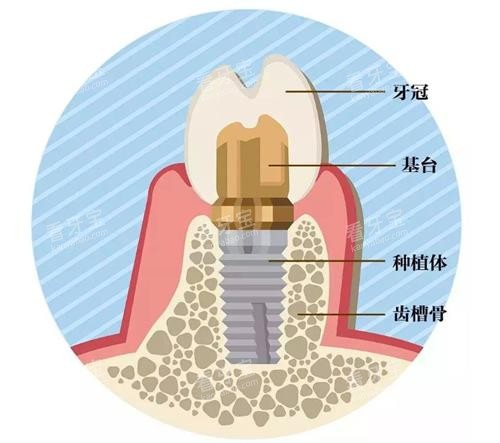 种植牙的组成 种植牙的组成