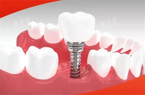 赣州金铂利口腔种植牙 赣州金铂利口腔种植牙