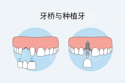 牙冠桥和种植牙对比图 牙冠桥和种植牙对比图
