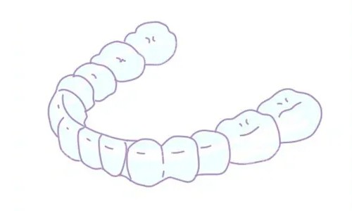 隐形矫正 隐形矫正