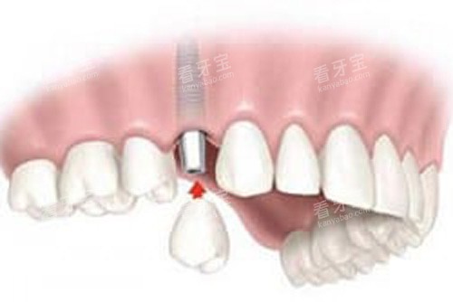 ������װ����ʾ��ͼ