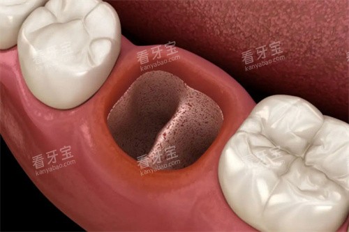 拔牙洞内部白色膜 拔牙洞内部白色膜
