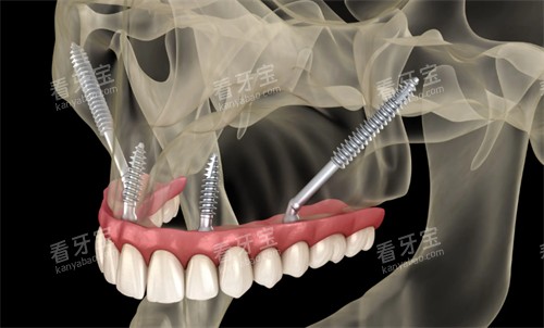 ���ڽ��еĴ�ȧ����