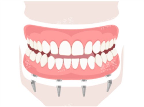 下牙床半口种植 下牙床半口种植
