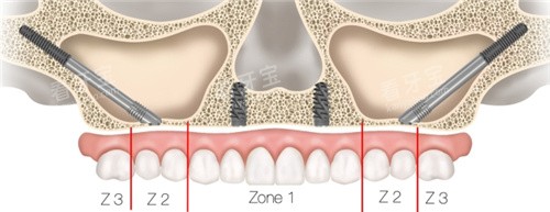 ��ȧ������ֲ����ͼ��