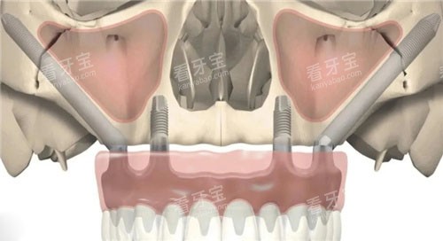 ��ȧ������ֲ����ͼ