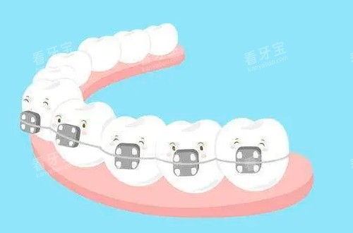 传统牙齿矫正器动画展示图 传统牙齿矫正器动画展示图