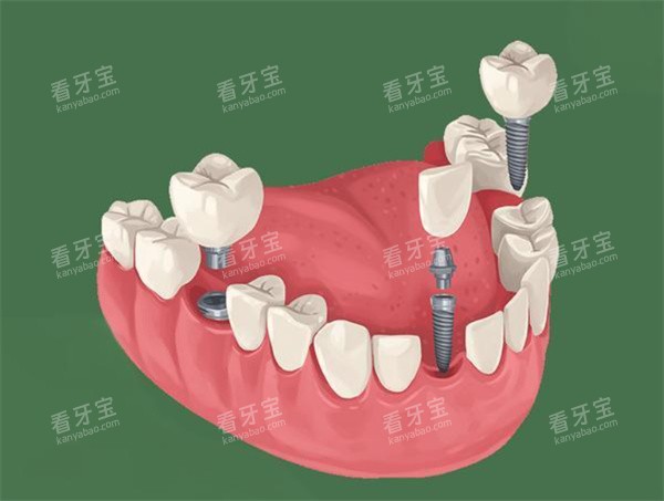种植牙卡通动画图展示 种植牙卡通动画图展示
