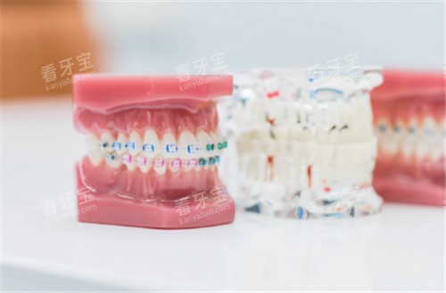 牙套模型图示 牙套模型图示