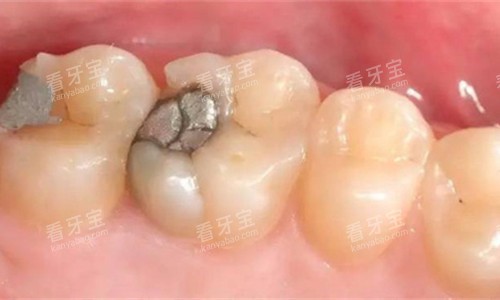 牙齿金属补牙图 牙齿金属补牙图