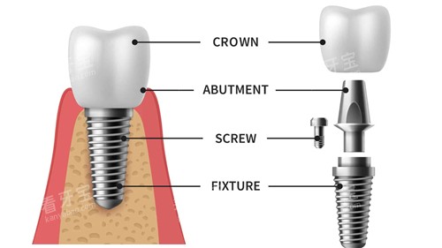 种植牙组成部分动画展示 种植牙组成部分动画展示