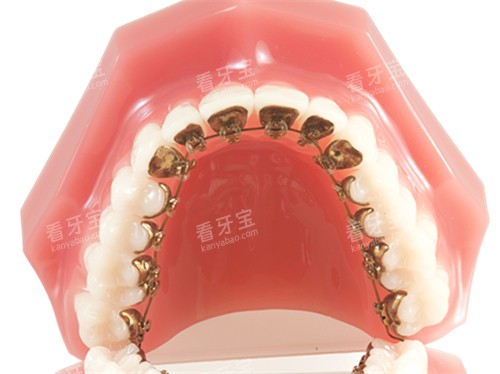 牙齿矫正金属舌侧矫正牙套模型 牙齿矫正金属舌侧矫正牙套模型