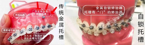 牙齿矫正牙套对比实物展示图 牙齿矫正牙套对比实物展示图