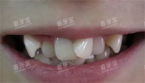 牙齿拥挤的照片 牙齿拥挤的照片