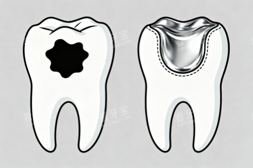 蛀牙补牙展示图 蛀牙补牙展示图