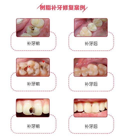 树脂补牙修复实例 树脂补牙修复实例