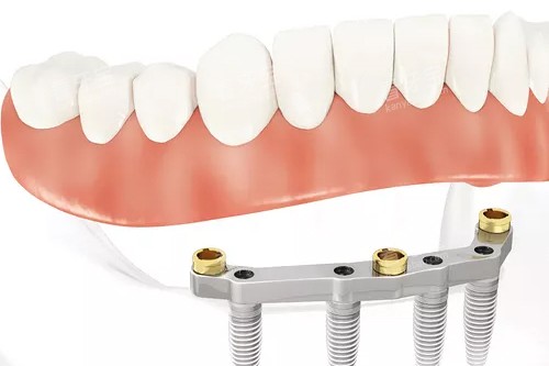 半口种植牙联排牙冠示意图 半口种植牙联排牙冠示意图
