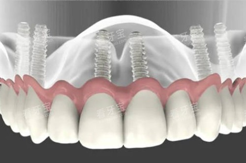 all-on-6��ֲģ��ͼ