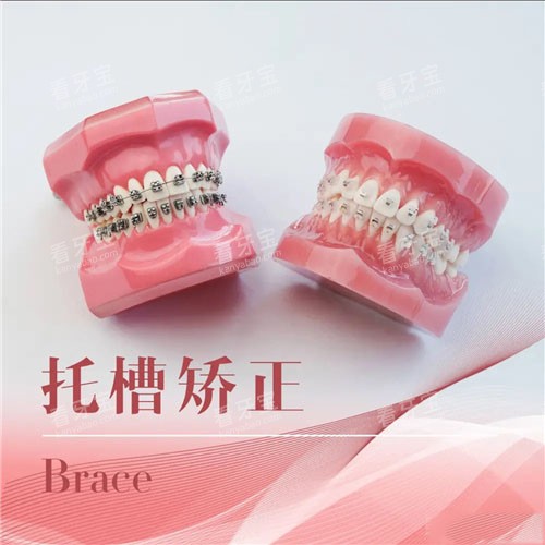 两种不同的托槽矫正 两种不同的托槽矫正