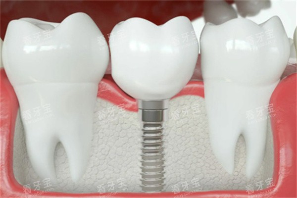 单颗种植牙内部图 单颗种植牙内部图