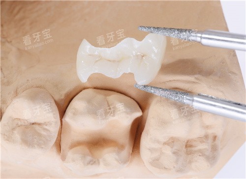 补牙高位嵌体 补牙高位嵌体