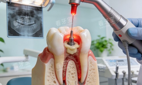 根管治疗图片示意 根管治疗图片示意