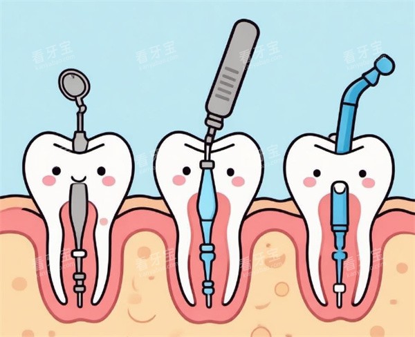 牙齿根管治疗卡通图展示 牙齿根管治疗卡通图展示