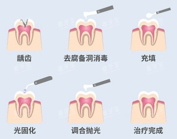 补牙步骤展示图 补牙步骤展示图