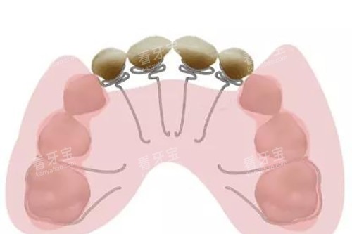 推簧卡通示意图 推簧卡通示意图