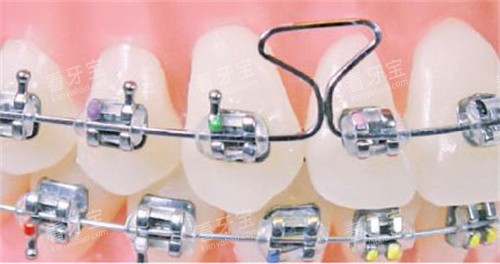 矫正弓丝 矫正弓丝