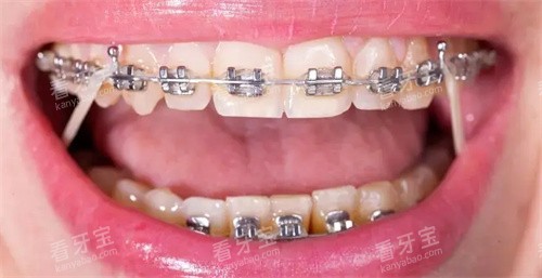 矫正细节图 矫正细节图