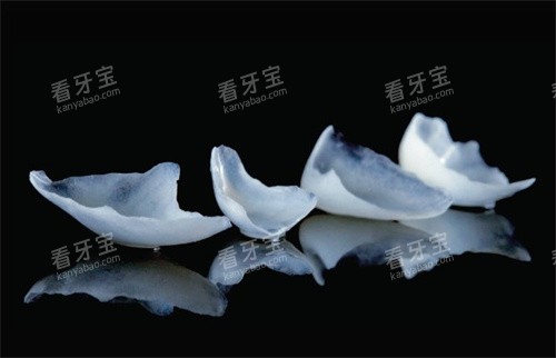 铸瓷贴面 铸瓷贴面