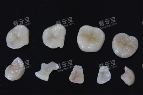 铸瓷嵌体 铸瓷嵌体