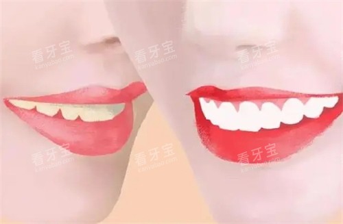 牙齿美白前后对比图 牙齿美白前后对比图